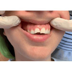 Faccette dentali: Prima e Dopo